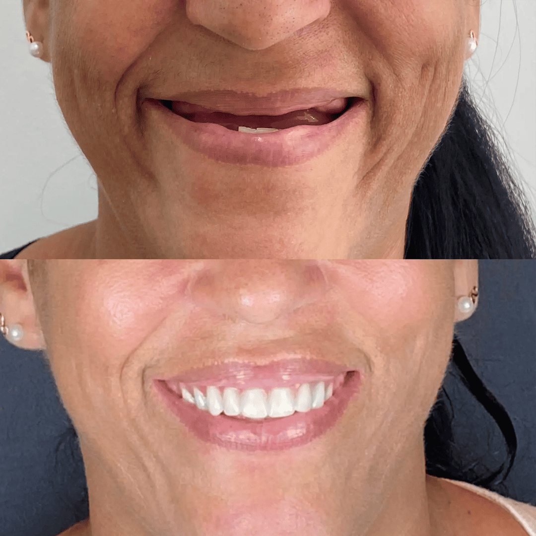 Antes e depois - Paciente 2