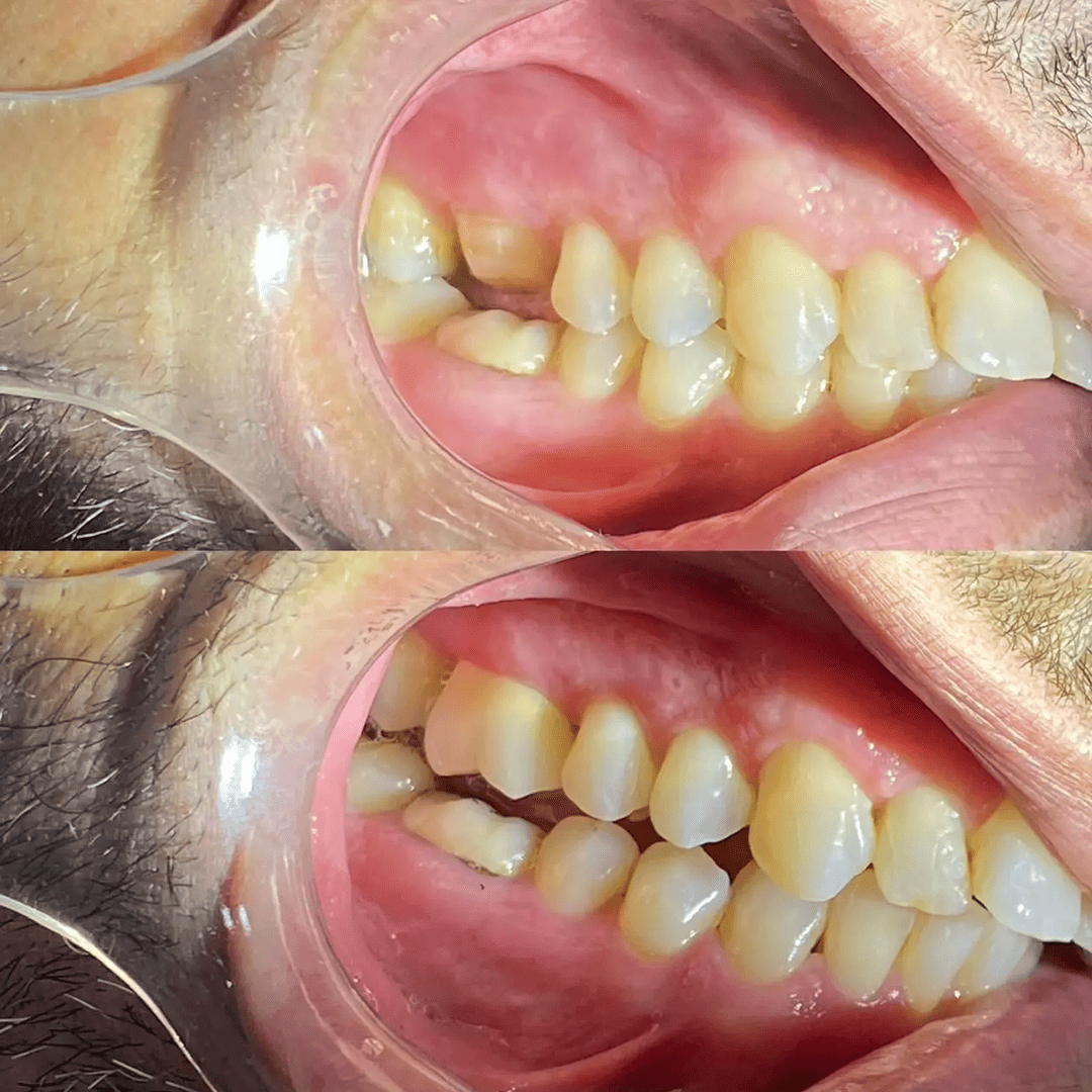 Antes e depois - Paciente 3