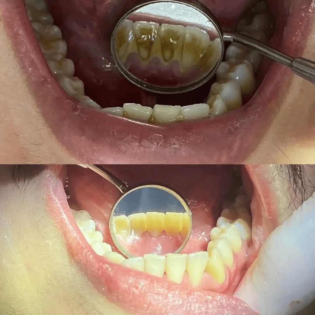 Antes e depois - Paciente 4
