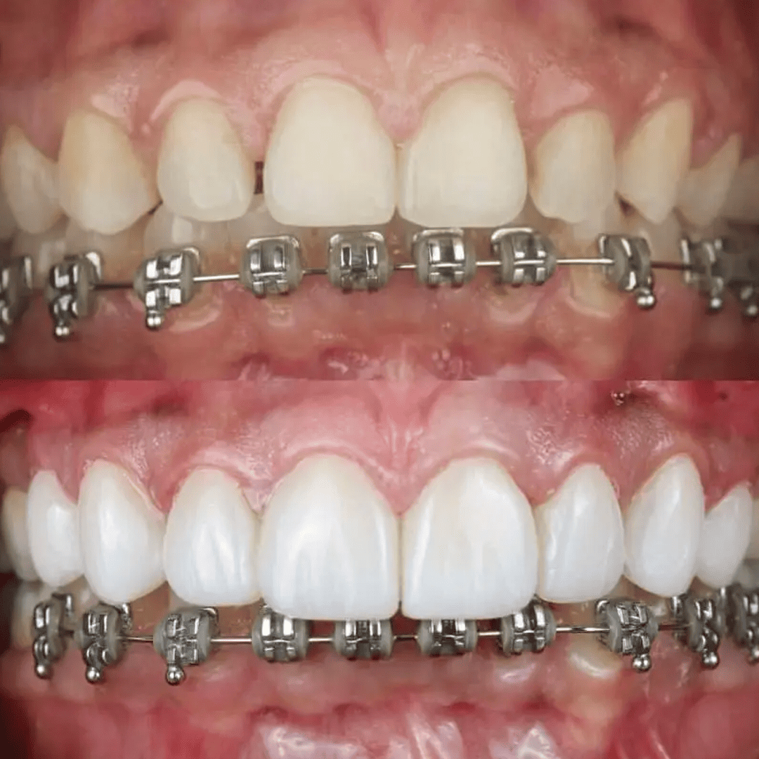 Antes e depois - Paciente 5
